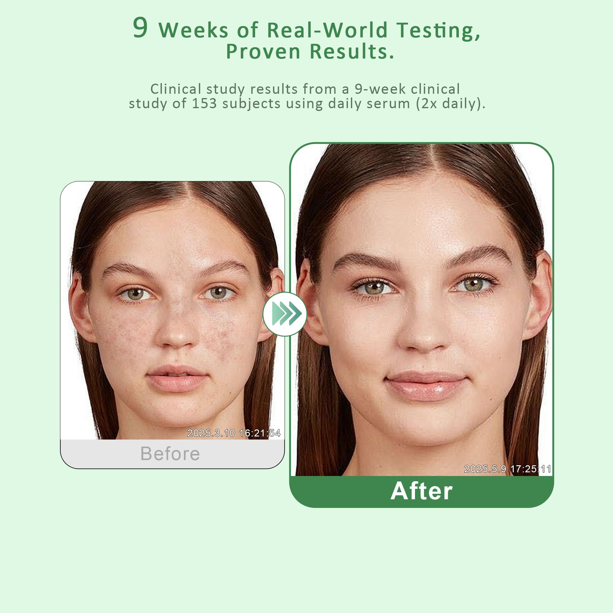 VBBV Dark Spot Remover Serum for Face & Body – Hyperpigmentation & Melasma – 1.7 fl oz
