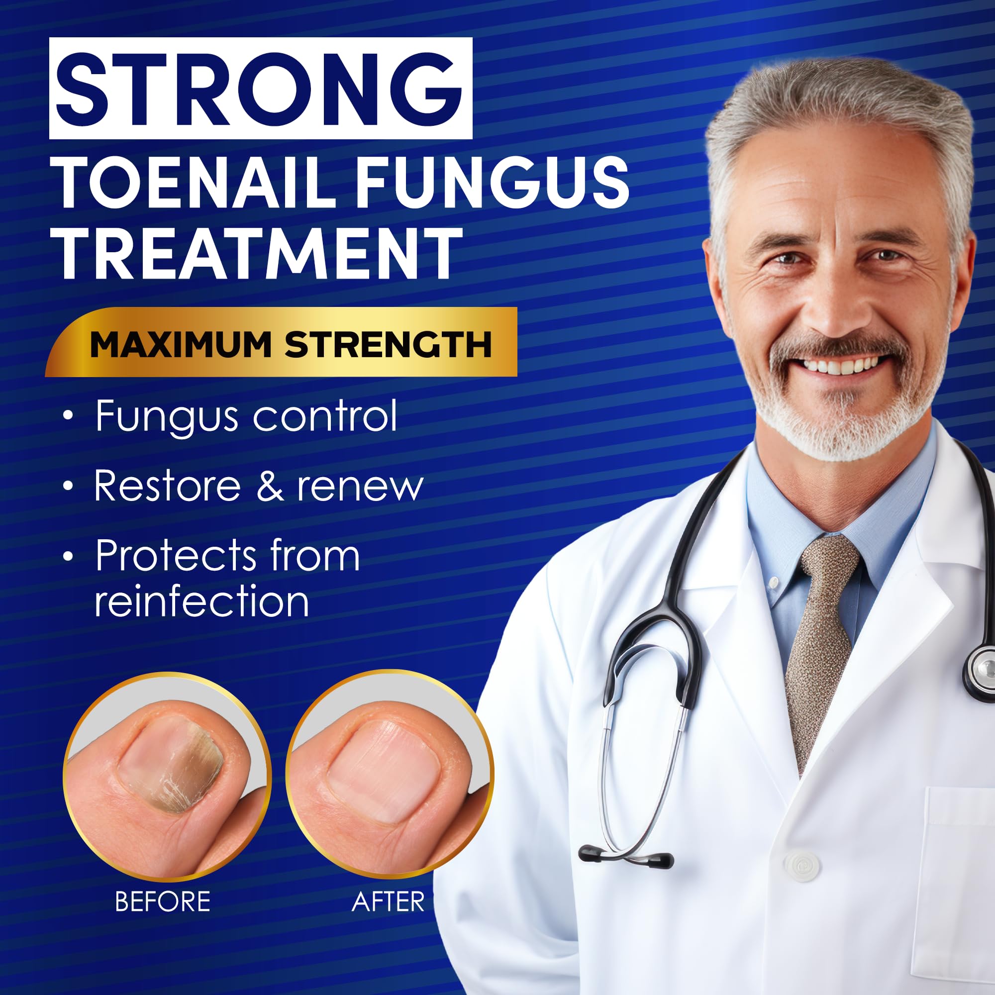 VTROUY Toenail Fungus Treatment Extra Strength – 2-Bottle Set with 25% Undecylenic Acid & Tea Tree Oil