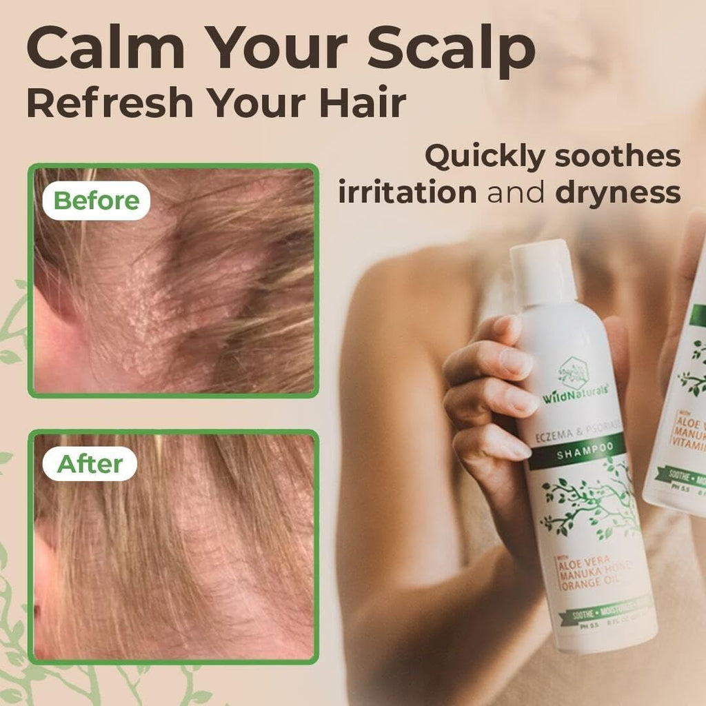 Wild Naturals Psoriasis Shampoo for Scalp Care & Relief | Hydrating Anti-Dandruff