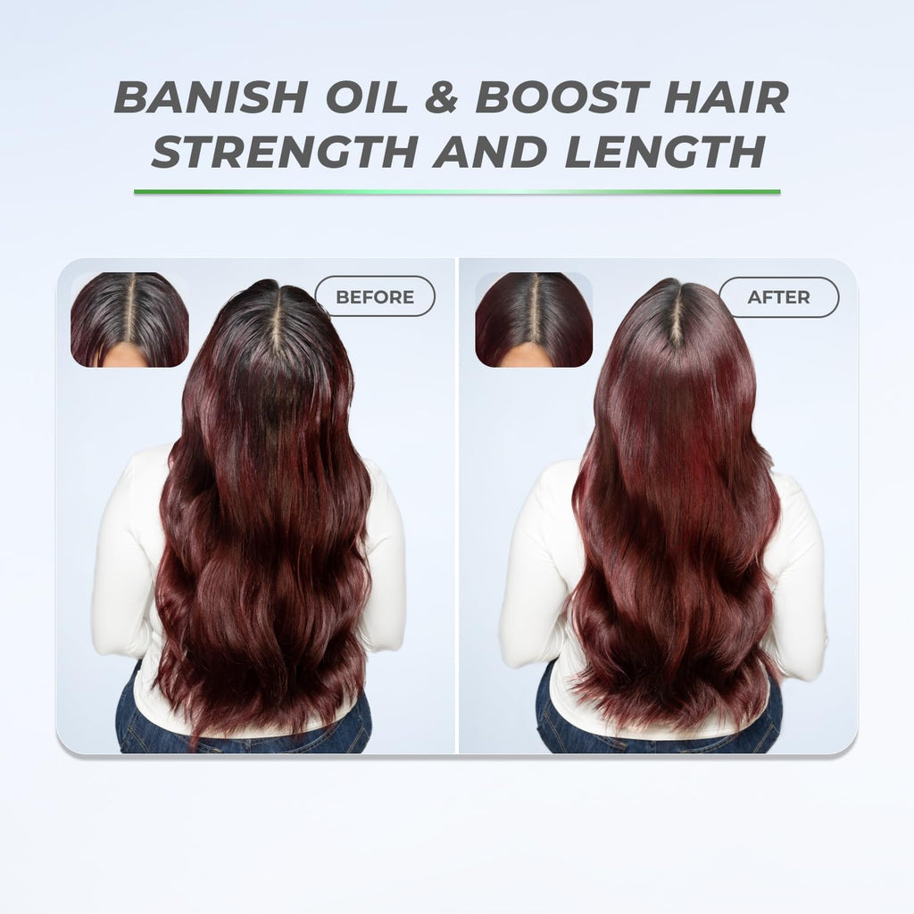 XMONDO Hair BOOST X Dry Shampoo – Saw Palmetto for Scalp Care, Talc-Free, Dermatologist Tested, 5 oz