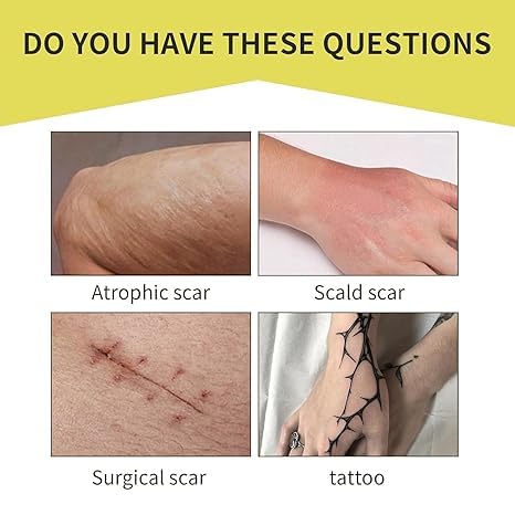 XUEVORIY Tattoo Cover Up Tape - Ultra-Thin Waterproof Patch for Tattoos, Scars & Birthmarks (4pcs, Fair Skin Tone)