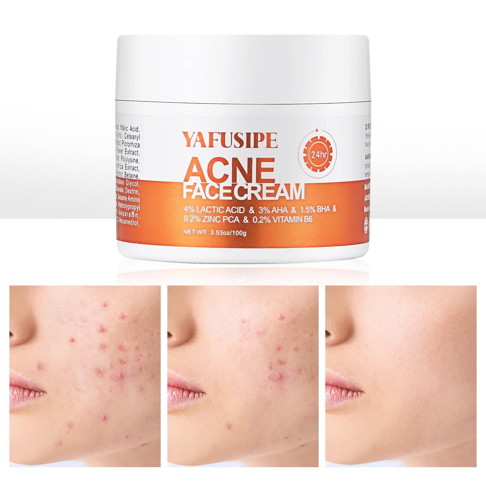 YAFUSIPE Acne Treatment Cream for Cystic Breakouts – Gentle, All-Skin-Types Formula