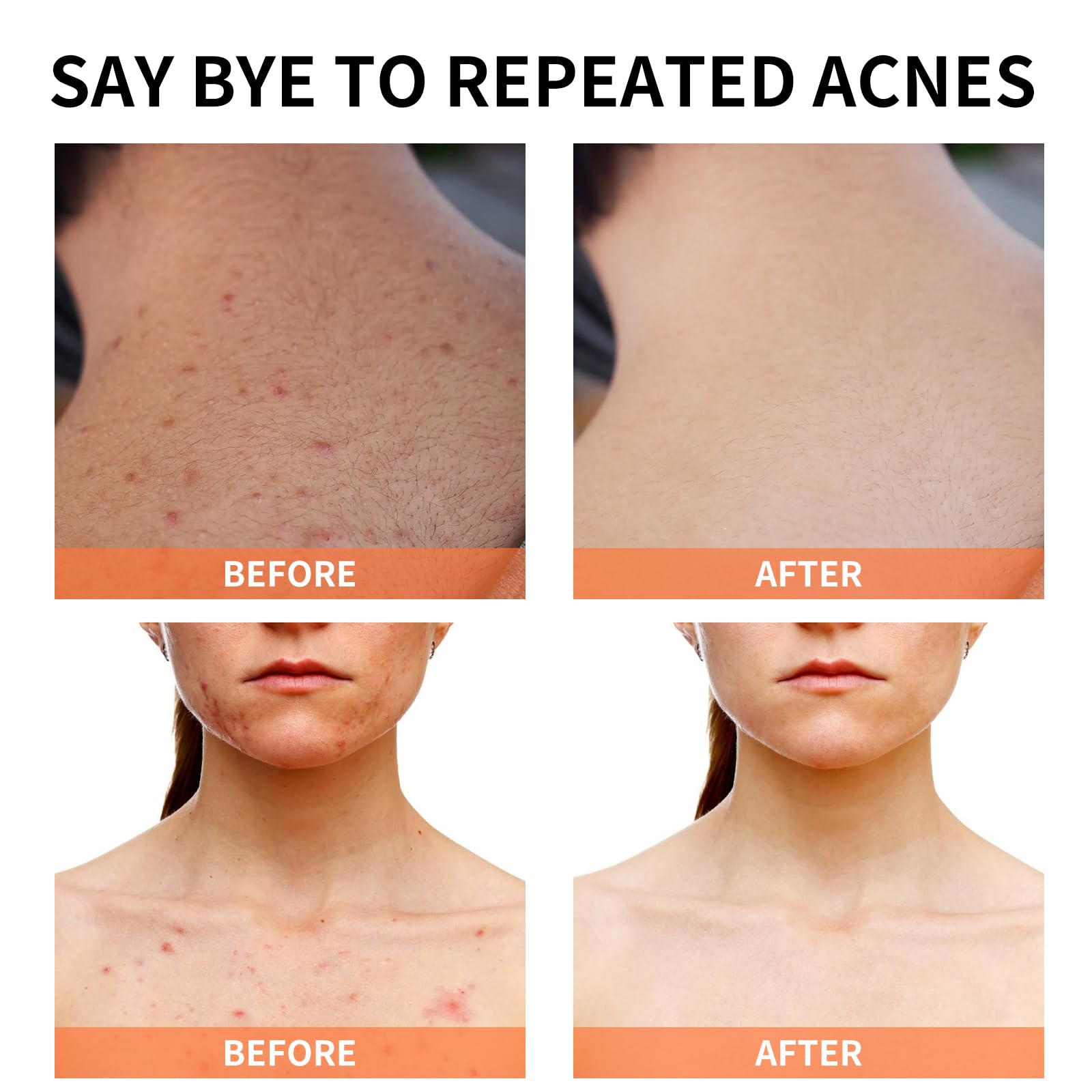 YAFUSIPE Acne Treatment Cream for Cystic Breakouts – Gentle, All-Skin-Types Formula