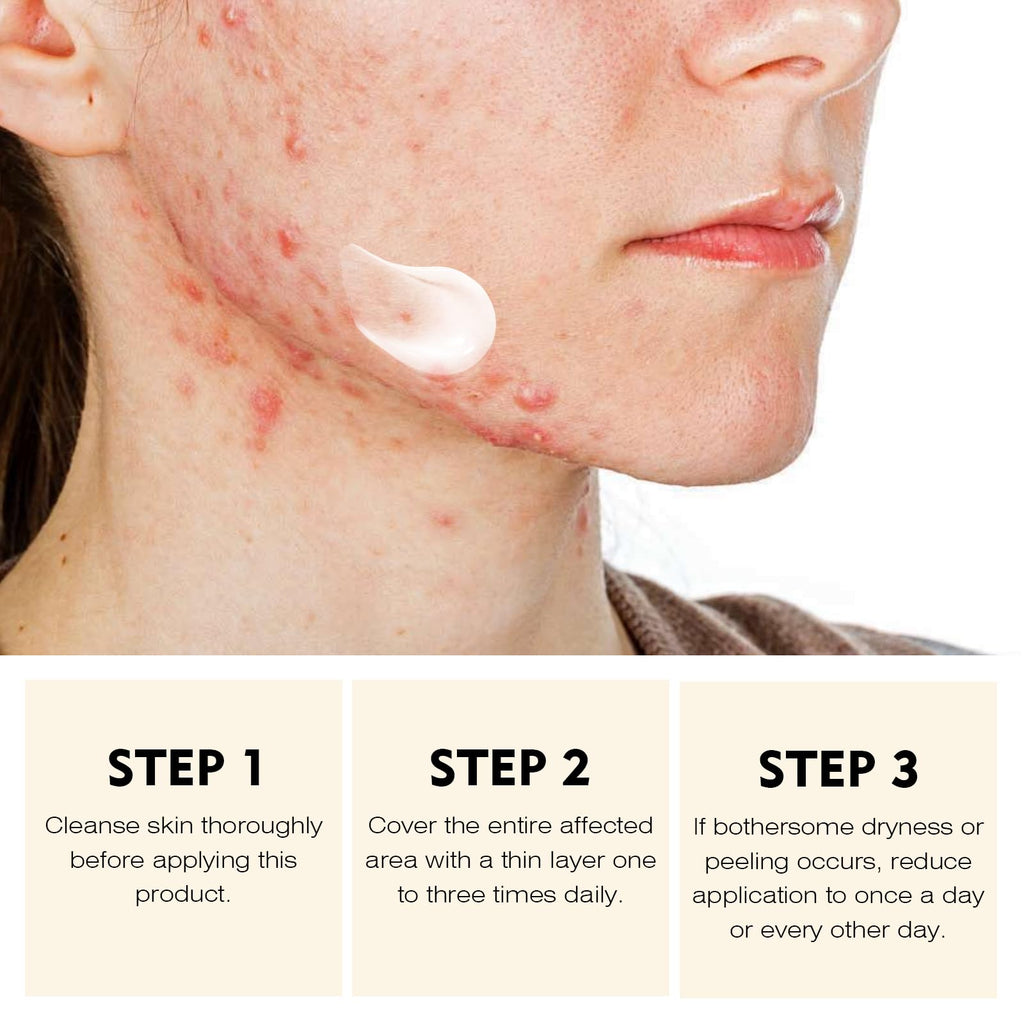 YAFUSIPE Acne Treatment Cream for Cystic Breakouts – Gentle, All-Skin-Types Formula