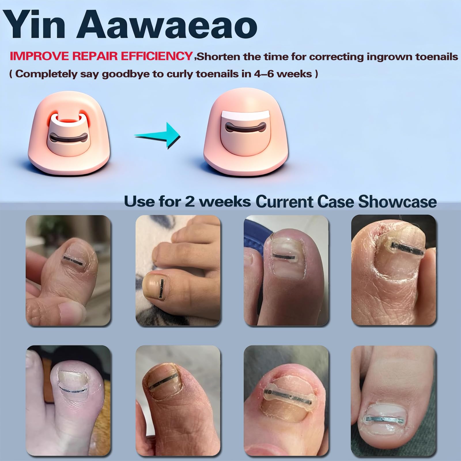 Yin Aawaeao Titanium Alloy Ingrown Toenail Treatment — Waterproof Patch Kit for Curved Nails