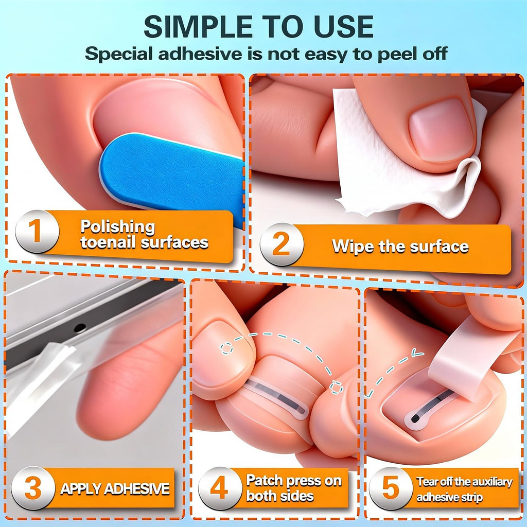 Yin Aawaeao Titanium Alloy Ingrown Toenail Treatment — Waterproof Patch Kit for Curved Nails