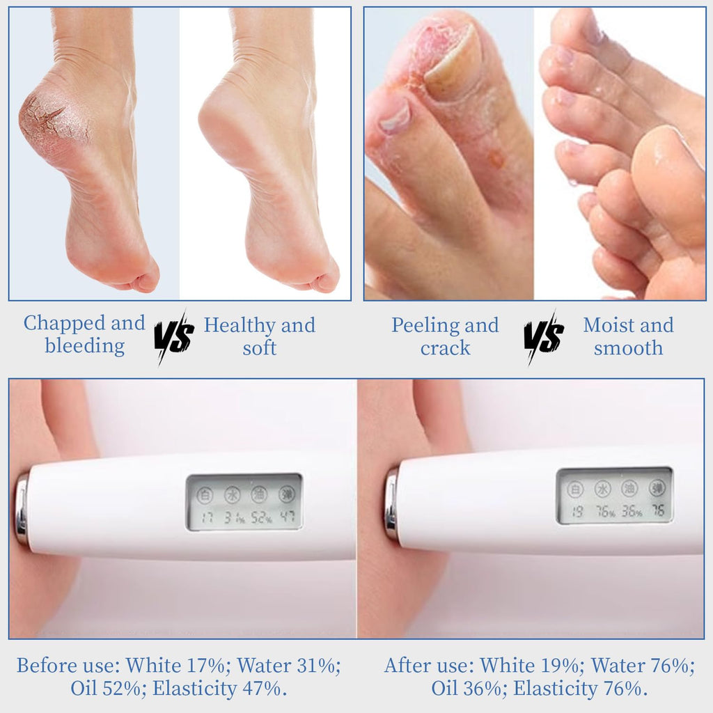 YOUNGYOUNGLOVE 70% Urea Cream with 2% Salicylic Acid – 10.1 oz