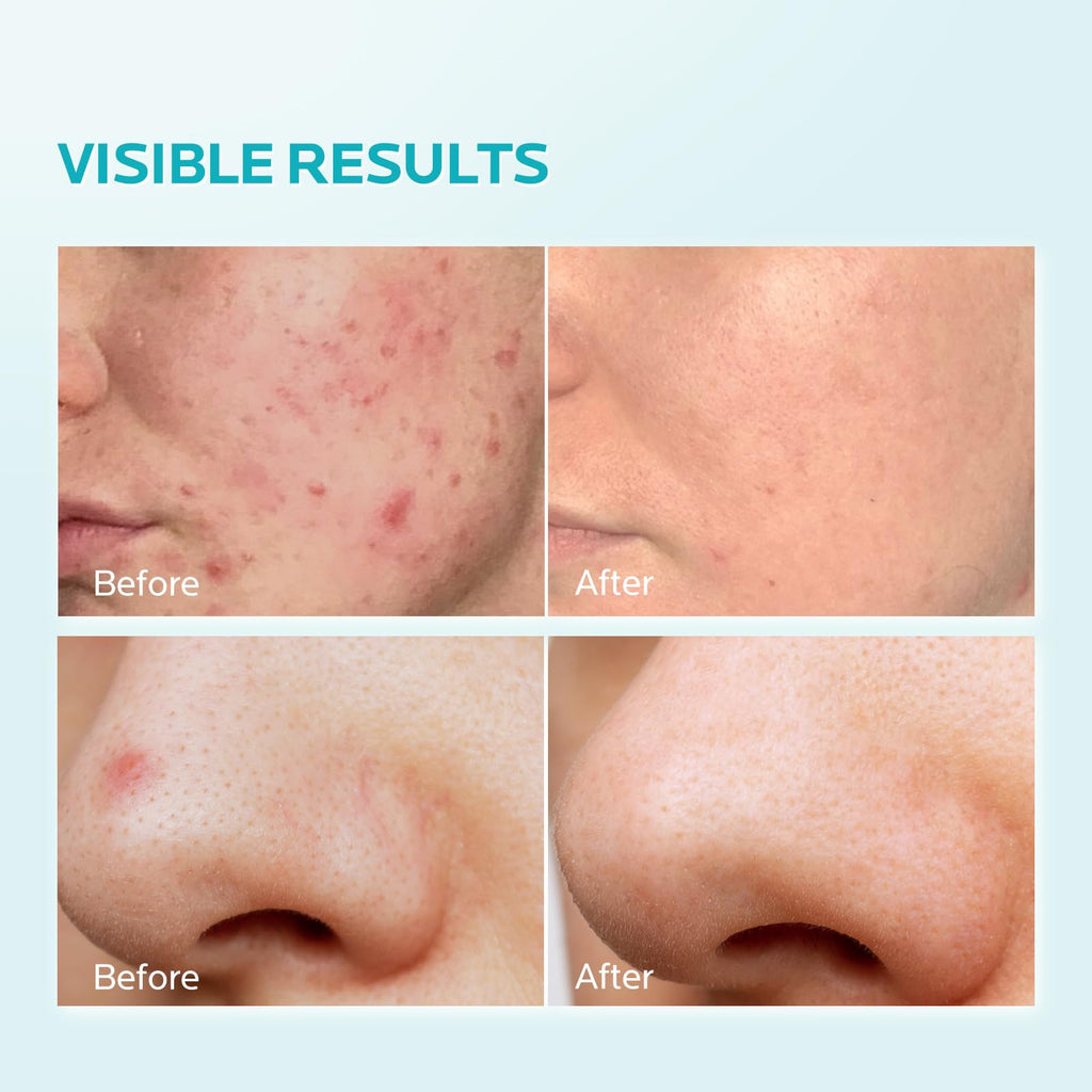 ZealSea 10% Azelaic Acid Facial Cream with AHA & Pionin - Gentle, Barrier-Supporting Formula